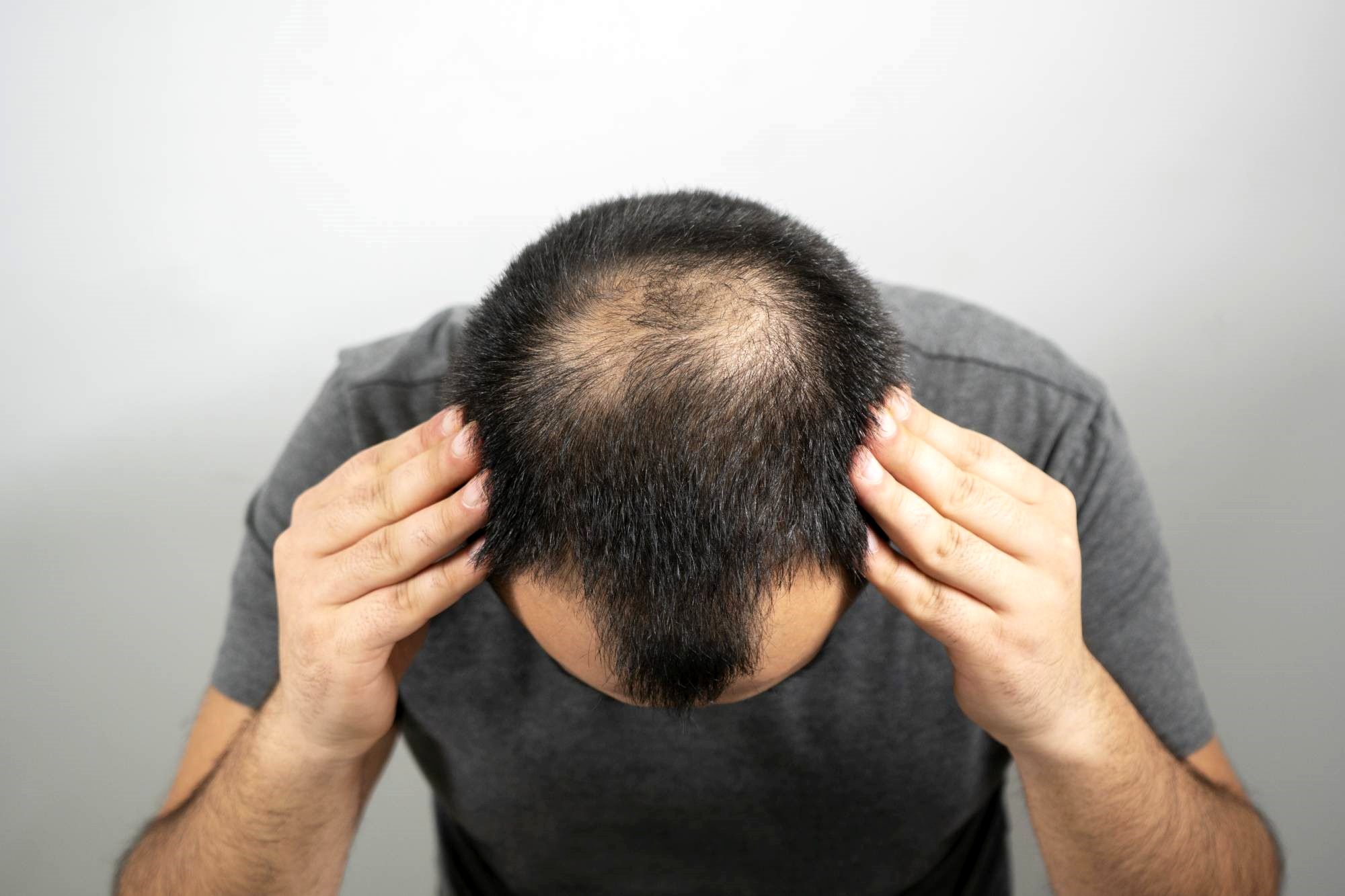 الگوهای رشد مجدد مو